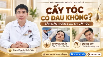 Cấy Tóc Có Đau Không? Cảm Giác Trong & Sau Khi Cấy Tóc