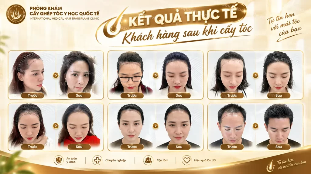 Hình ảnh khách hàng hạ đường chân tóc tại Trung tâm cấy ghép tóc y học Quốc Tế