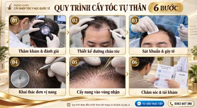 Quy Trình Cấy Tóc Tự Thân Chuẩn Y Khoa 6 Bước An Toàn 2026